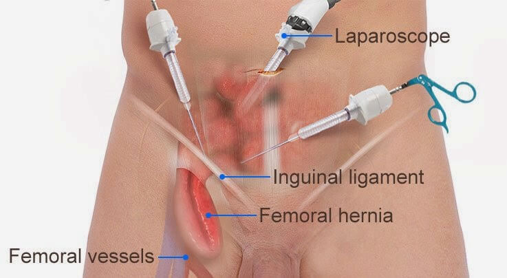 Laparoscopic-femoral-Hernia-repair  Μηροκήλη Laparoscopic femoral Hernia repair